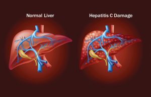 Hepatitis C and how it is transmitted